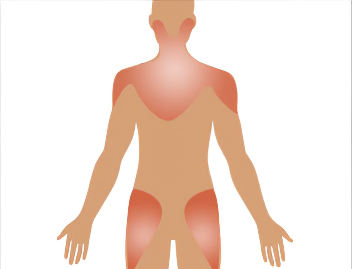 polymyalgia-rheumatica